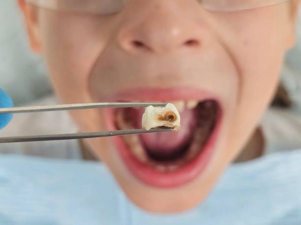 Best Knocked-Out Tooth (Avulsed Tooth) Treatment in Westminster, MD